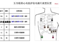 心电监护电极安装位置