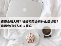 蟑螂会咬人吗？被螂咬后会有什么症状呢？ 蟑螂会叮咬人的皮肤吗