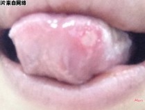 舌头溃疡的疗愈方式