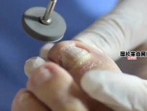 治疗足部灰指甲的有效方法有哪些？