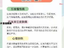 白癜风的治疗效果如何？