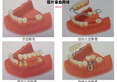 全口假牙的护理与维护方法