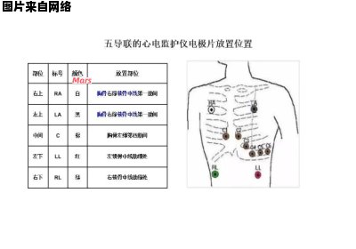 心电监护电极安装位置