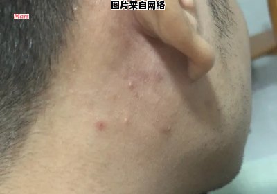 耳后长痘痘的原因是什么？