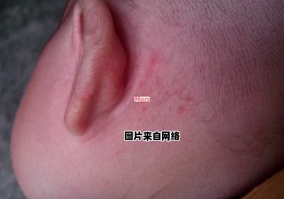 耳后长痘痘的原因是什么？