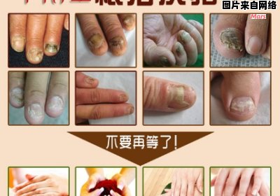 治疗灰指甲的土方法