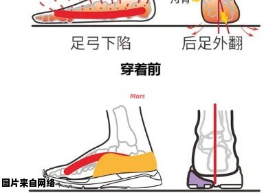 如何选择合适的鞋子来纠正扁平足问题