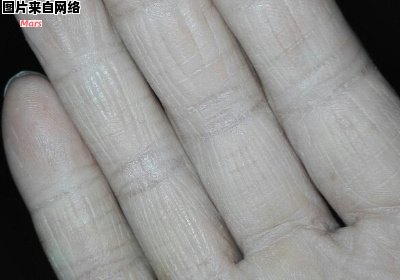 手部皮肤干燥开裂，疼痛难忍应该怎么处理？