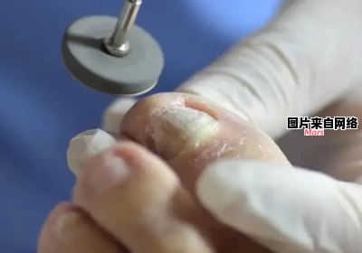 治疗足部灰指甲的有效方法有哪些？