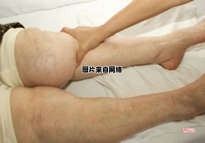 如何缓解偏瘫老人下肢水肿问题？