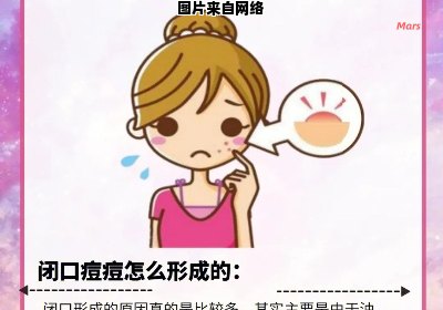 如何有效消除闭口痘痘的实用小妙招