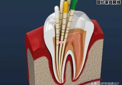 牙齿痛可以通过根管治疗解决吗？